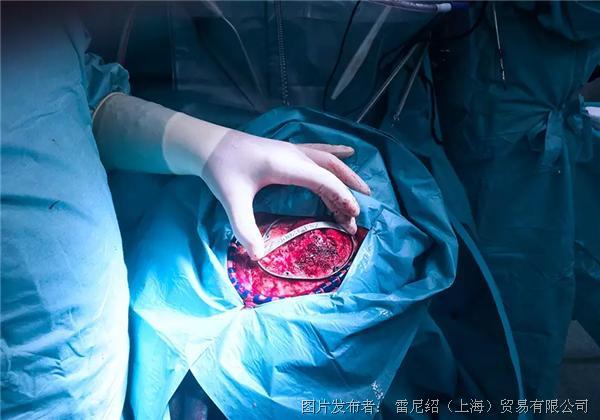 放置用于开颅手术的切割导板